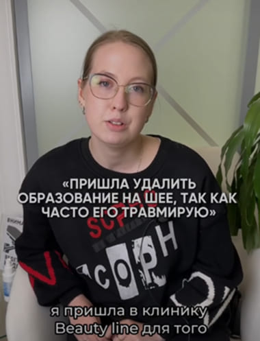 Удаление невуса