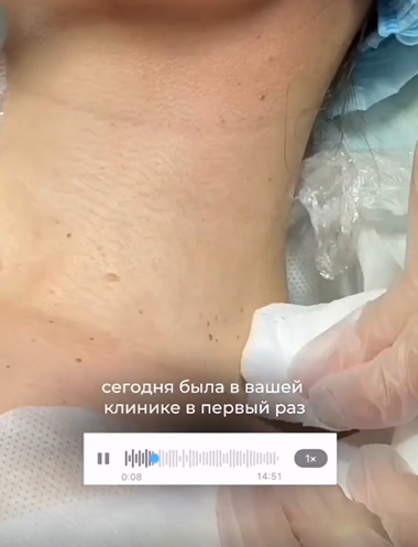 Удаление родинки