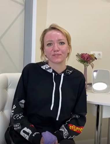 Лазерная шлифовка лица