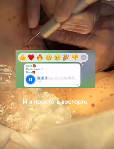 Удаление кератом