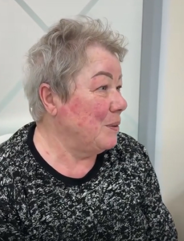 Удаление себорейных кератом