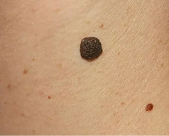 Удаление родинок