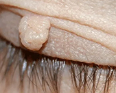 Удаление папиллом