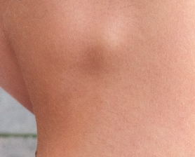 Удаление липом/атером