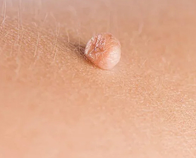 Удаление фибром