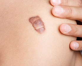 Удаление дерматофибром