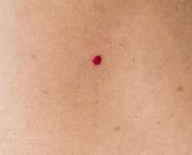 Удаление ангиом и сосудистых образований кожи у взрослых