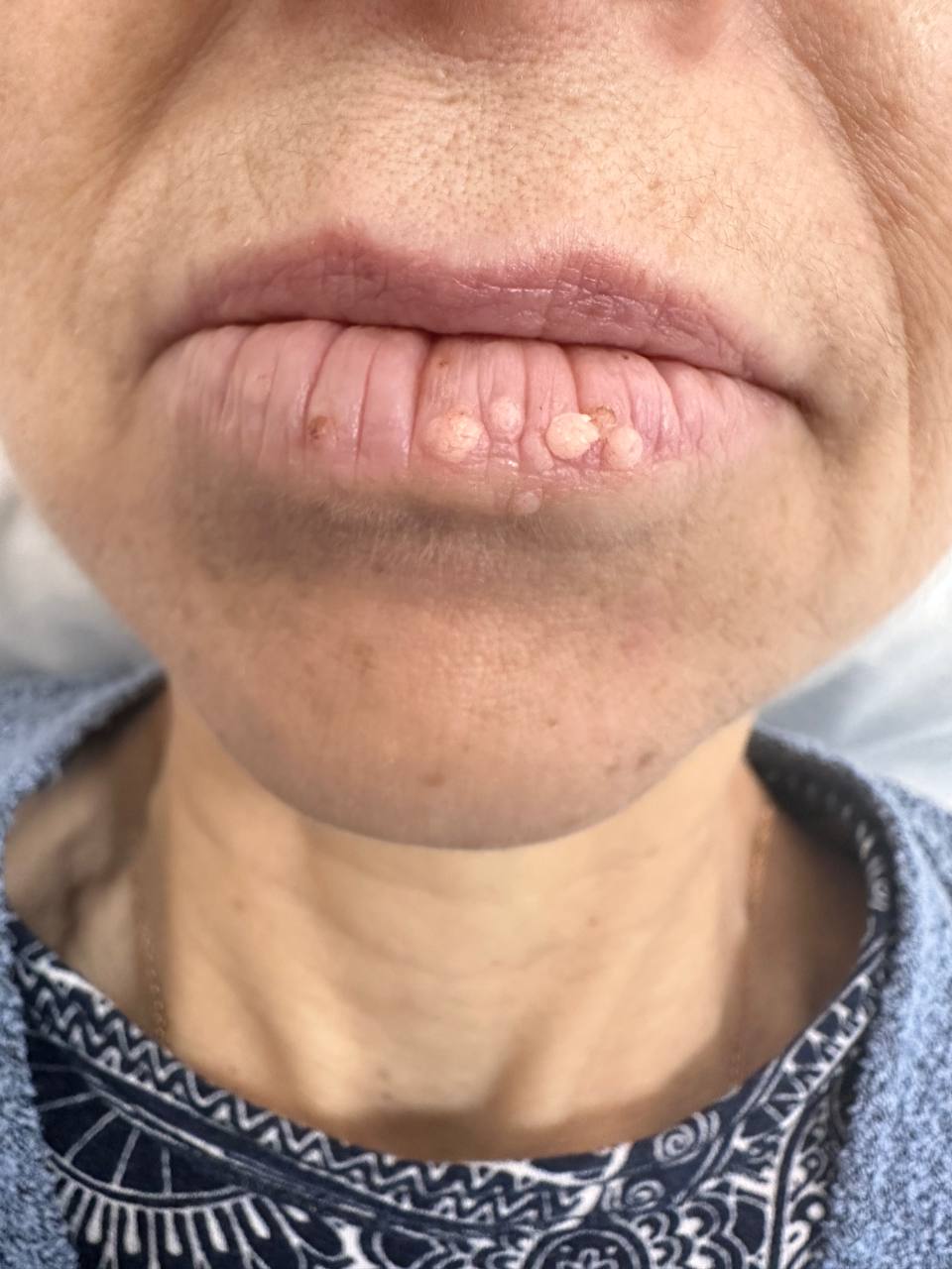 Удаление бородавок