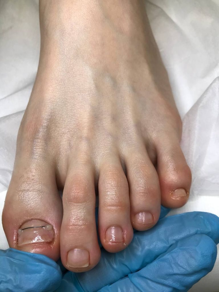 Безоперационное лечение вросшего ногтя: Коррекционные системы (Титановая нить, Podofix) или пластина?