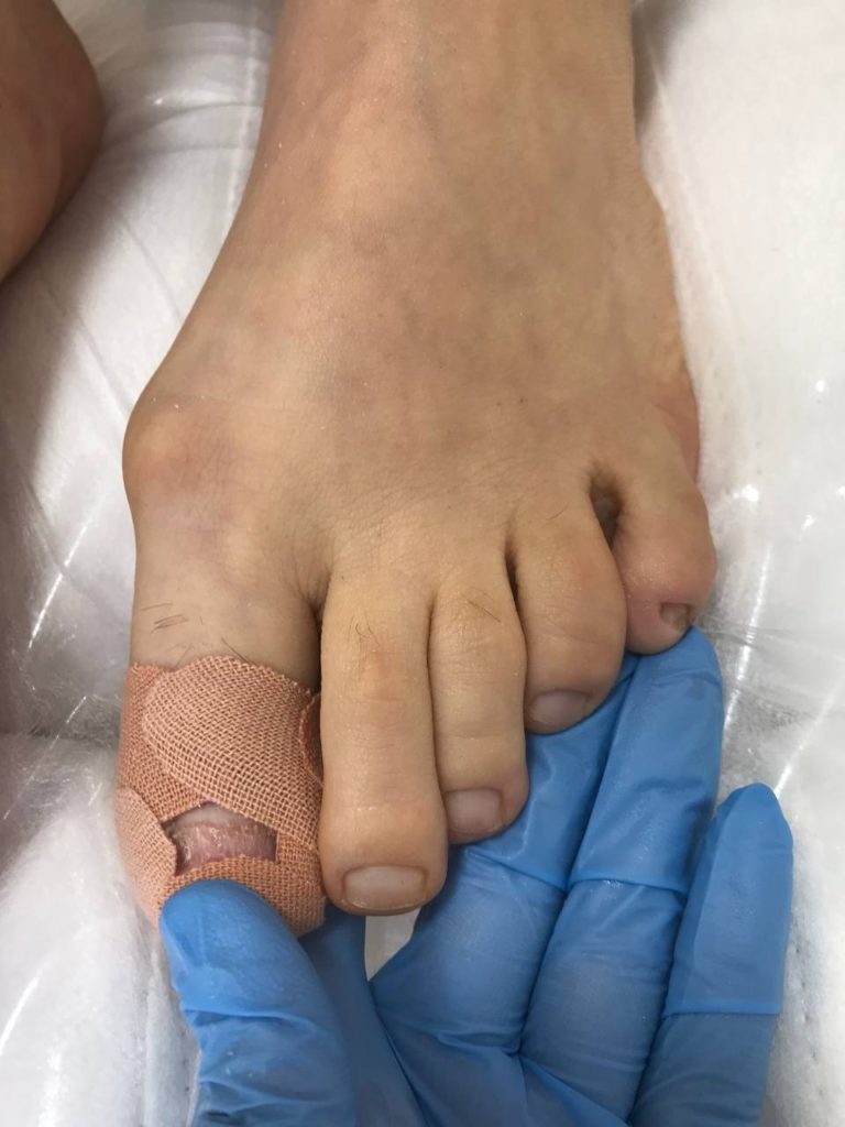 Тейпирование в подологии: как специальные ленты помогают при вросших ногтях и болях в стопе