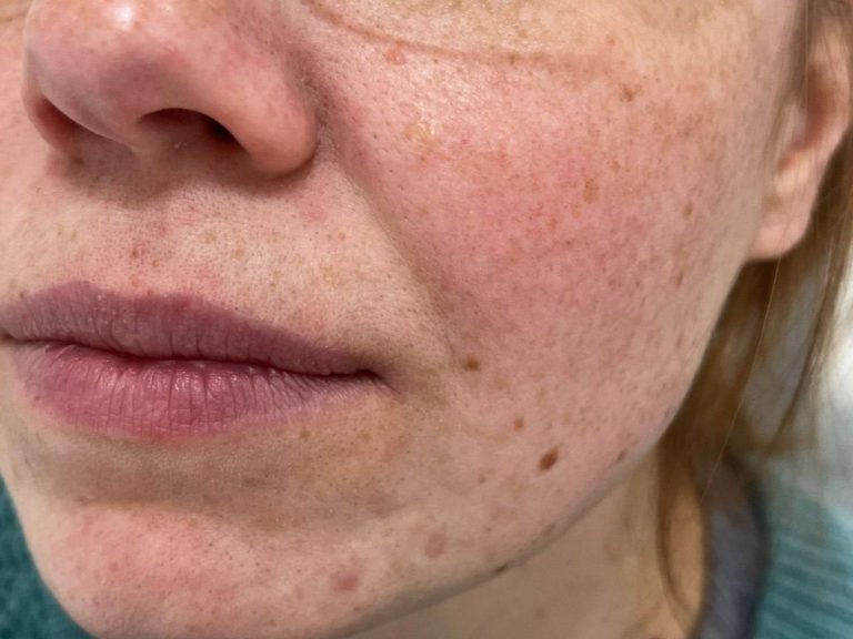 Белые и беспигментные родинки: опасны ли они и стоит ли их удалять?